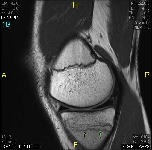 Figure 2 for case tibial fracture inferior to the physis